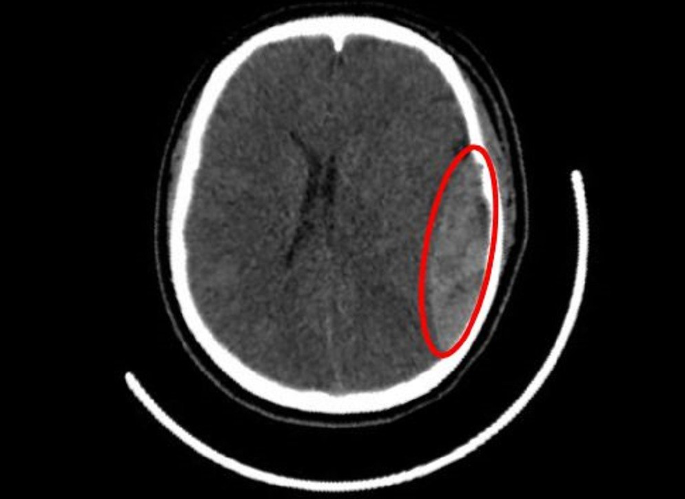 Bánh xe cuốn tà áo dài, nữ sinh bị đập đầu xuống đường nứt hộp sọ- Ảnh 1.