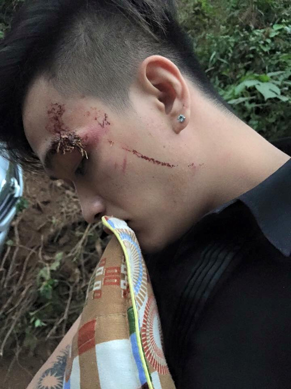 
Thành viên Titi - HKT bị thương nặng nhất.
