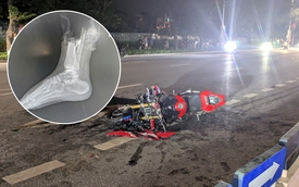 Kỳ tích 6 tiếng nối lại chân cho cô gái 19 tuổi sau tai nạn kinh hoàng với xe phân khối lớn ở Hà Nội